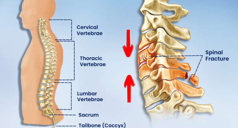 Understanding Spinal Fractures and Their Treatment