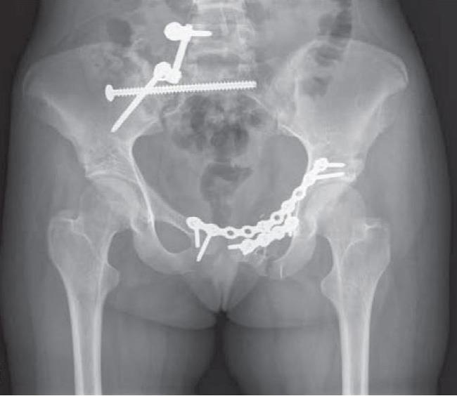 Overcoming Pelvic Fracture Challenges