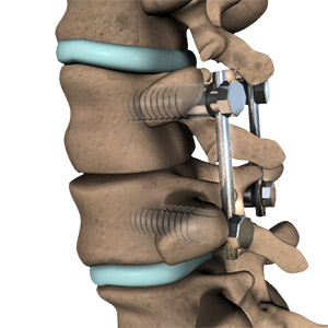Spine Fusion Surgery
